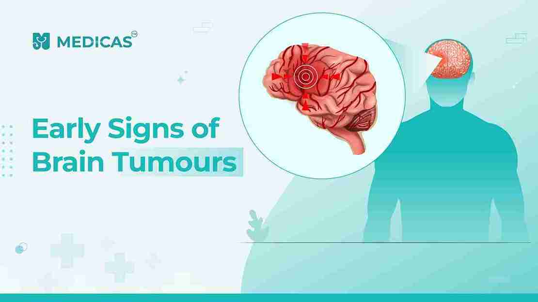 Brain Tumour Warning Signs